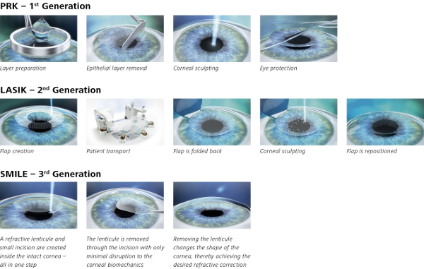 Image Showing The Difference Between PRK, LASIK and SMILE Laser Eye Surgeries