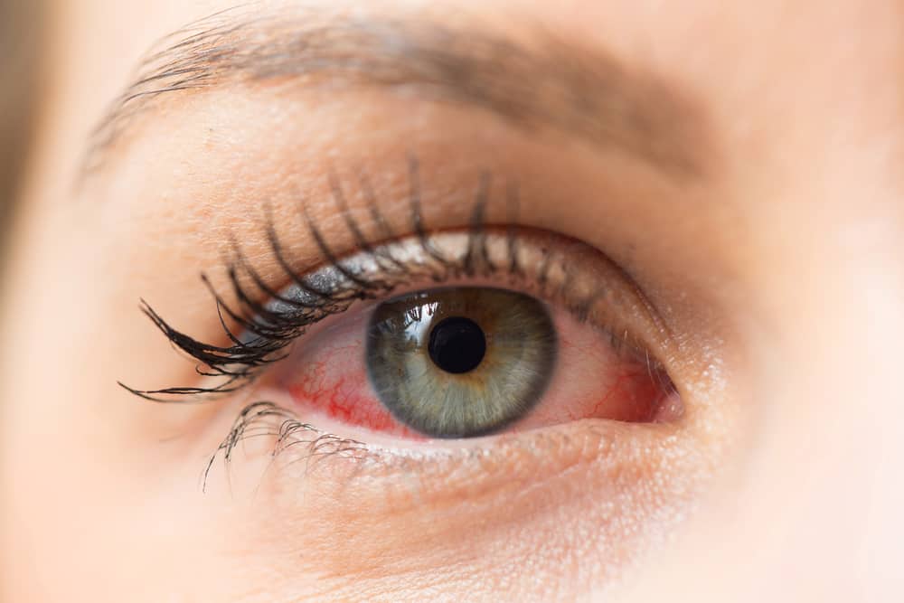 Woman with red, irritated eye