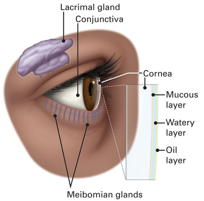 Diagram of eye with areas affected by dry eye syndrome and targeted by IPL treatment.