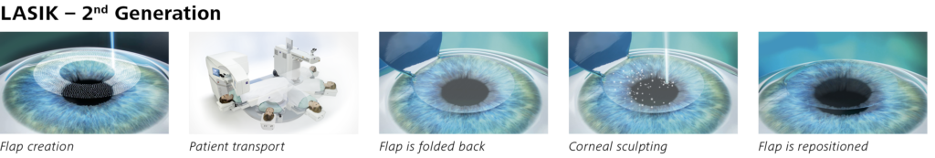 Steps of LASIK laser eye surgery