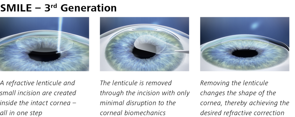 Steps to SMILE laser eye surgery