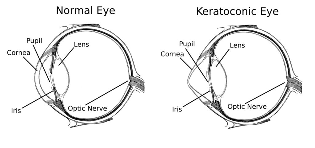 normal cornea vs keratoconic cornea