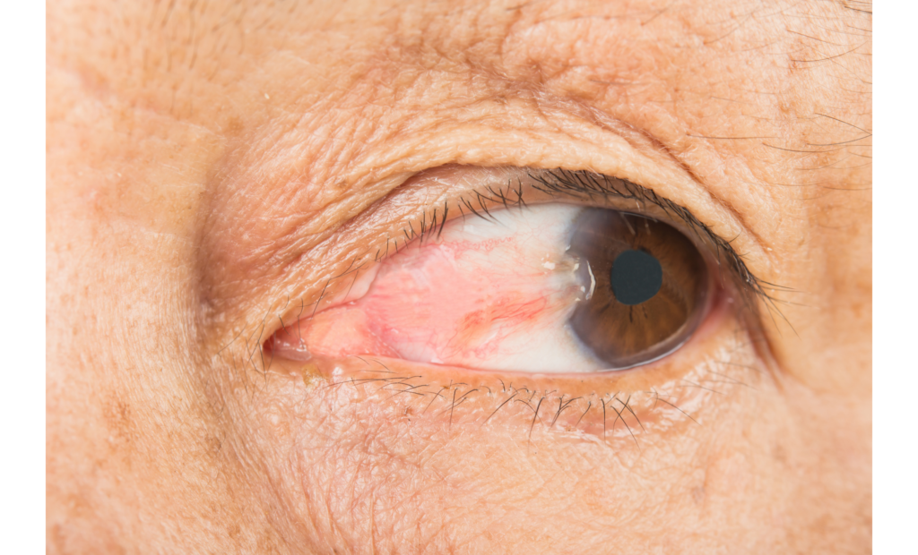 Pterygium on eye extending on to cornea